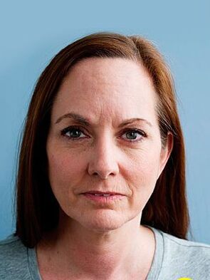 Joannas Haut, bevor sie die Eudalie -Creme benutzte
