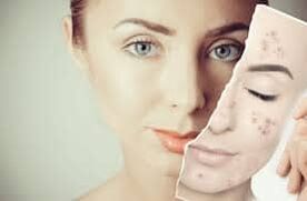 Botox -Ersatz